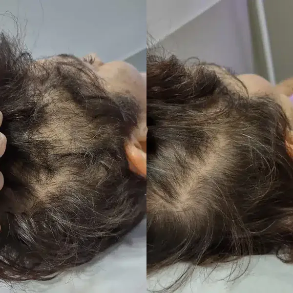 Antes e depois de tratamento capilar, couro cabeludo com mais densidade de fios depois