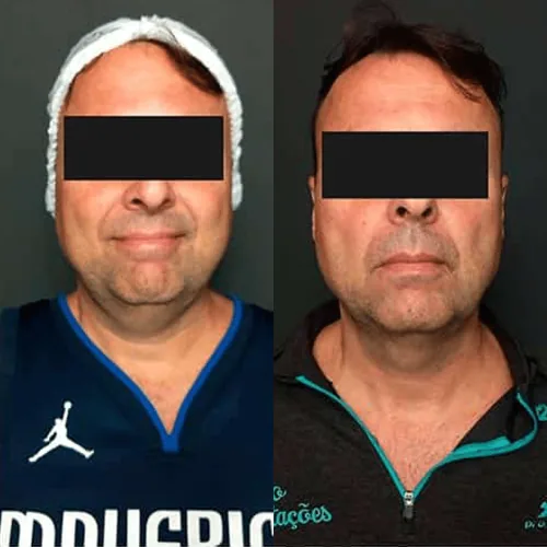 Antes e depois de tratamento facial, homem em vista frontal, com contorno do rosto e papada mais definidos depois