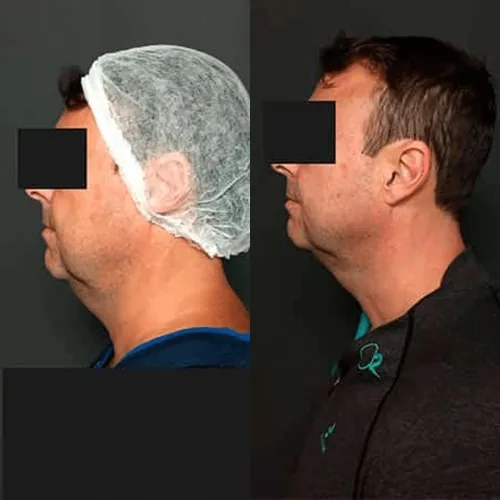 Antes e depois de tratamento facial, homem de perfil, com linha da mandíbula mais marcada depois