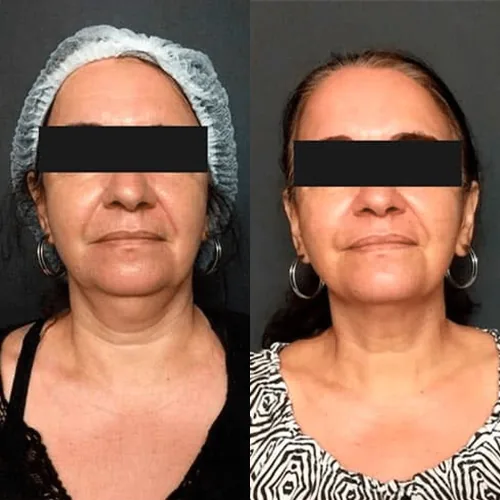 Antes e depois de tratamento facial, mulher em vista frontal, com pele do rosto e pescoço mais firme depois