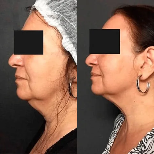 Antes e depois de tratamento facial, mulher de perfil, com contorno da mandíbula e papada mais definidos depois