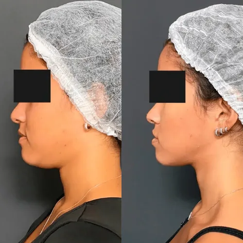 Antes e depois de tratamento facial, mulher jovem de perfil, com contorno do queixo mais definido depois